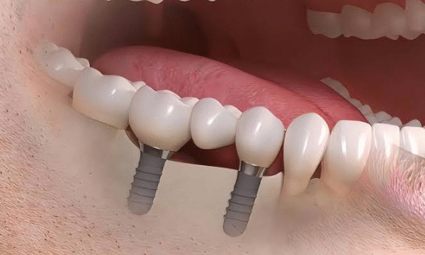 Dental Implants London Ontario: A Long-Term Solution for Missing Teeth