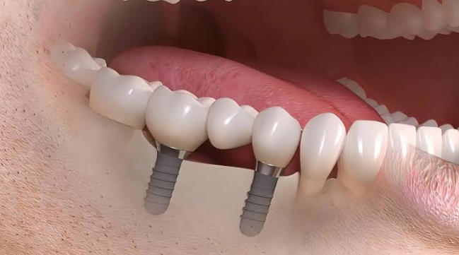Dental Implants London Ontario: A Long-Term Solution for Missing Teeth